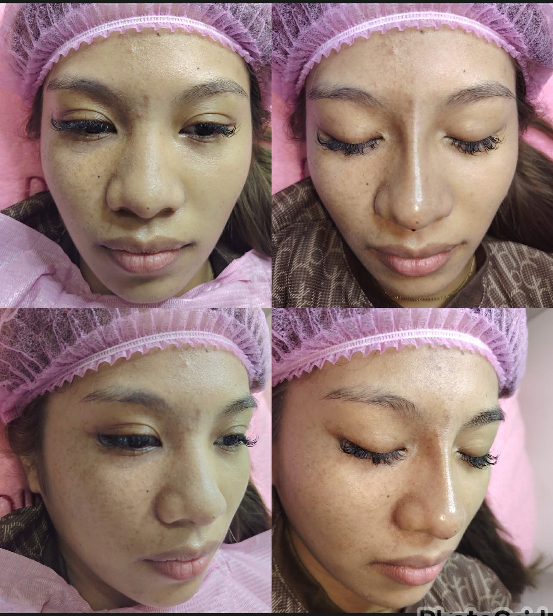 Botox forehead result
